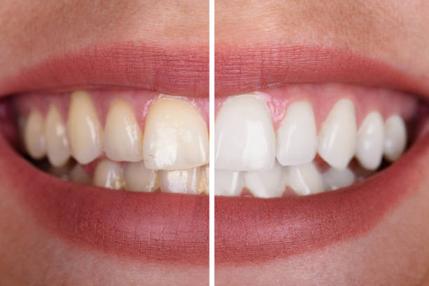 close up of a smiling woman's teeth before and after whitening